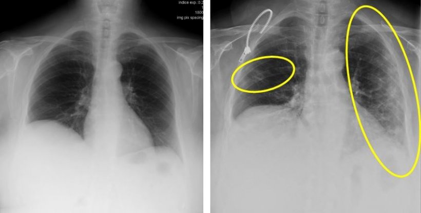 covid-19-infection-lungs-xray-scan
